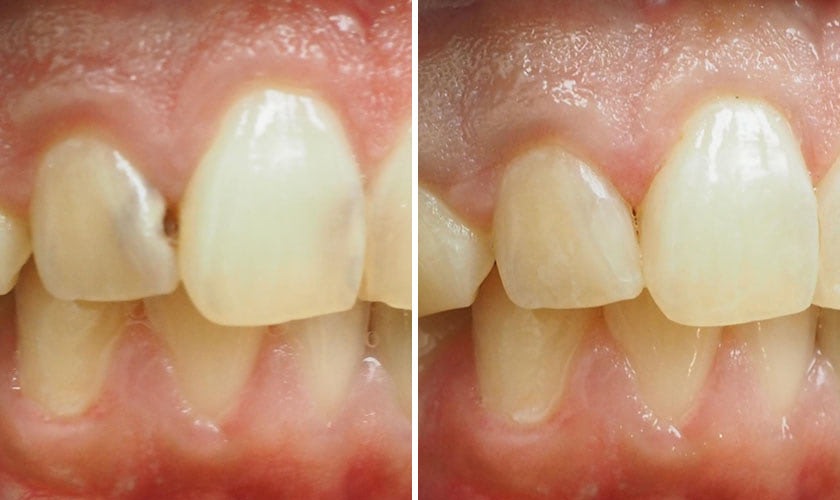 Trám kẽ răng thường được sử dụng trong các trường hợp sâu nhẹ