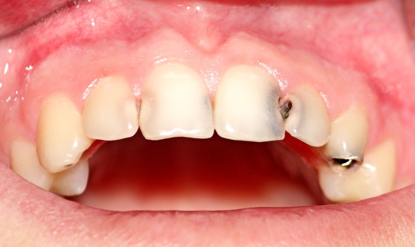 Sâu kẽ răng là tình trạng khá phổ biến