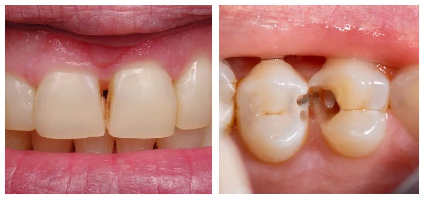 Sâu kẽ răng cửa và sâu kẽ răng hàm