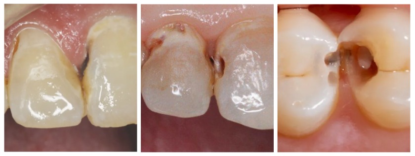 Các giai đoạn tiến triển của sâu kẽ răng