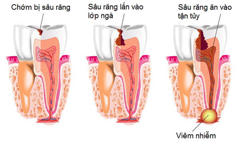 Diễn tiến của bệnh sâu răng