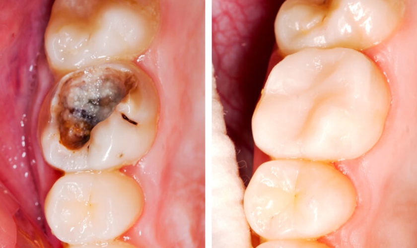 Nếu sâu răng chưa chạm tới tủy có thể khắc phục bằng kỹ thuật hàn trám