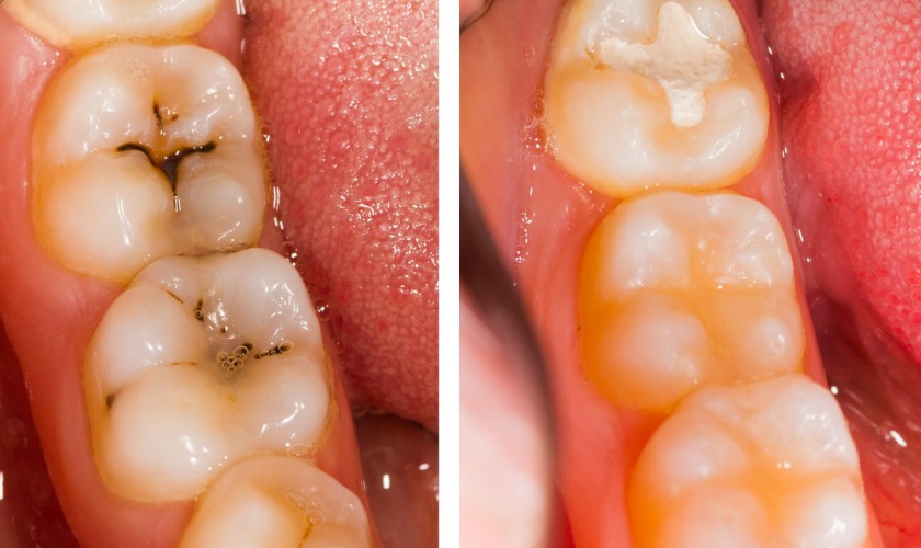 Phương pháp trám răng sâu