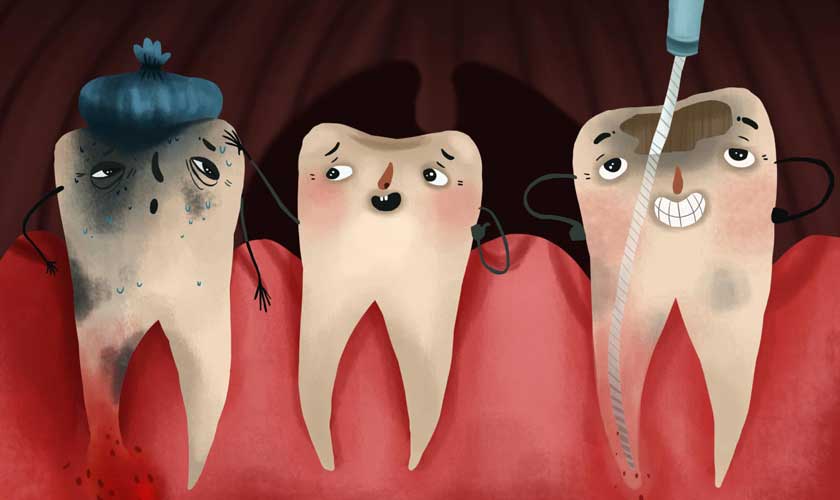 Sâu răng tiến triển nếu không được điều trị kịp thời Sâu răng tiến triển nếu không được điều trị kịp thời