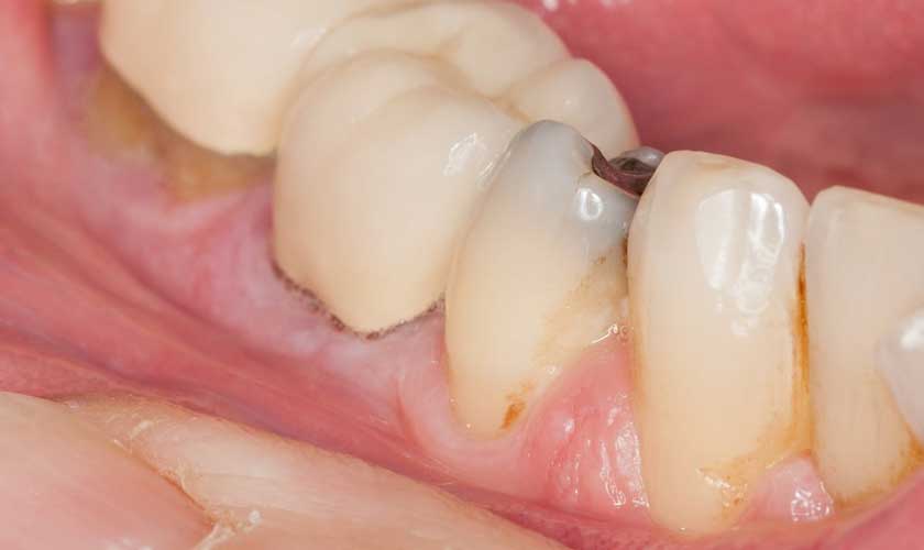 Răng bị sâu gây mất thẩm mỹ và giảm sức ăn nhai Răng bị sâu gây mất thẩm mỹ và giảm sức ăn nhai