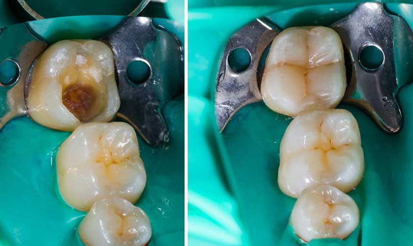 Trước và sau điều trị sâu răng