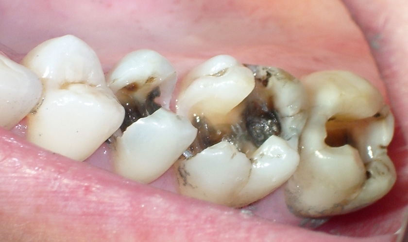 Sâu răng có nhiều mức độ