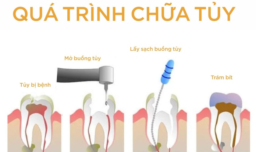 Điều trị tủy
