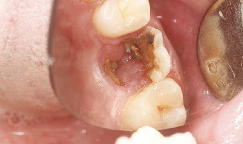 Sâu răng dưới nướu – Nguyên nhân và cách điều trị