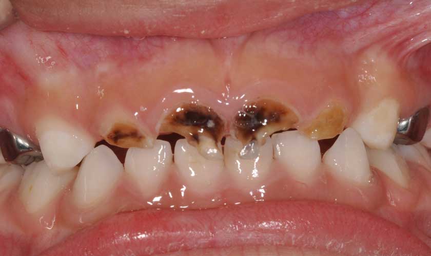 Tùy vào tình trạng sâu răng mà sẽ có phương pháp điều trị phù hợp