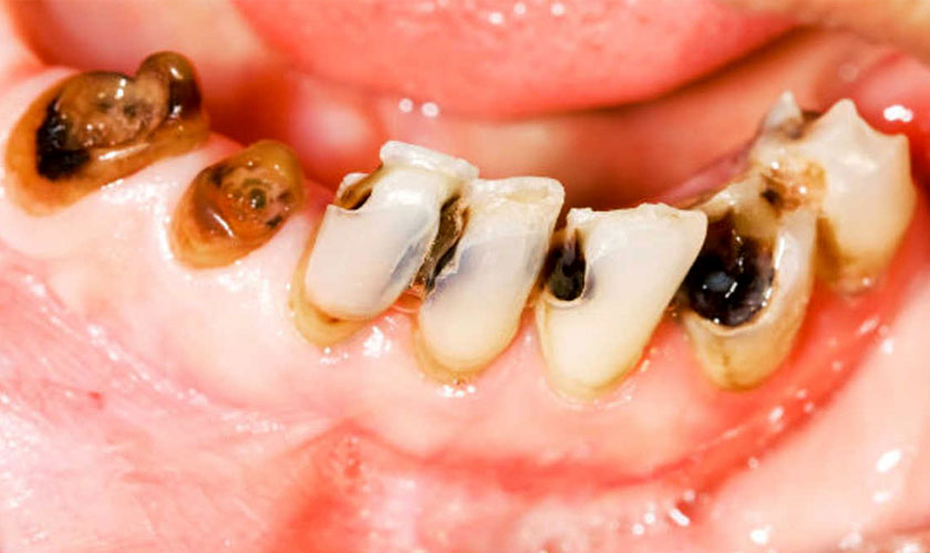 Khi sâu răng vừa chớm nên được hàn trám