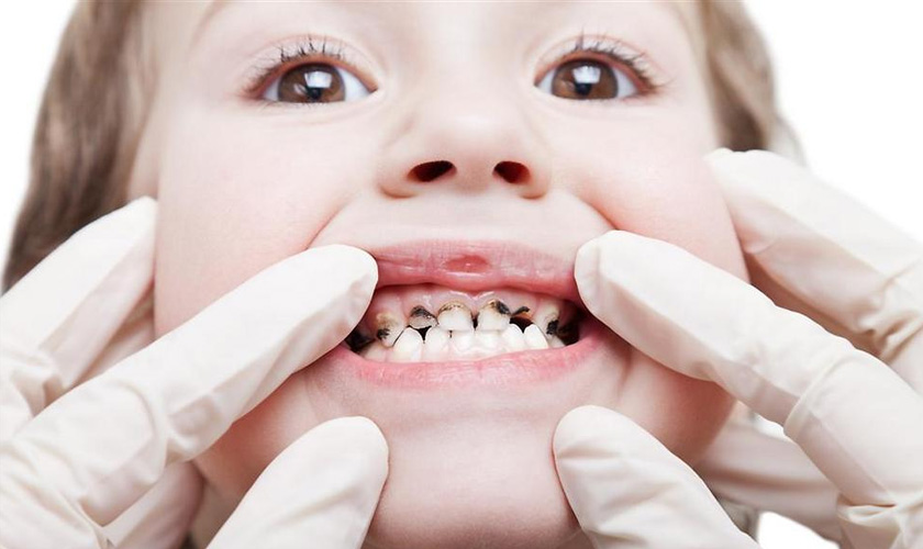 Cha mẹ nên hạn chế cho trẻ ăn bánh kẹo, đồ ngọt... để hạn chế sâu răng