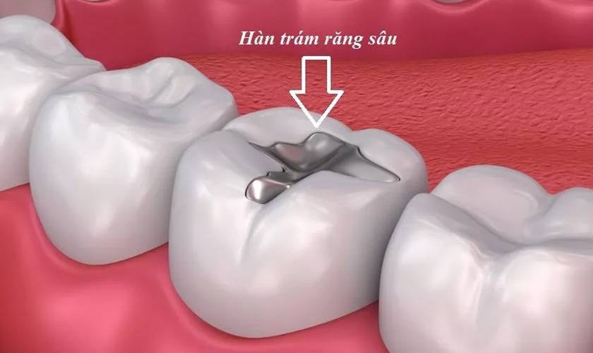trám răng sâu