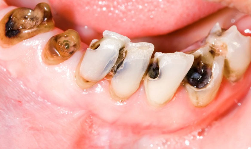 4 cách làm trắng răng tại nhà đơn giản mà không tốn tiền