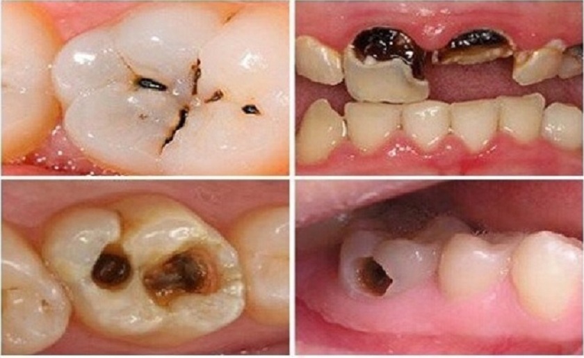 Ảnh minh họa bệnh lý sâu răng