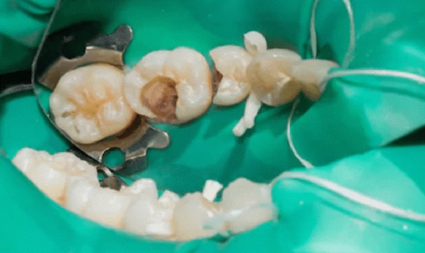 Đặt đế cao su để giữ răng cần điều trị được khô ráo