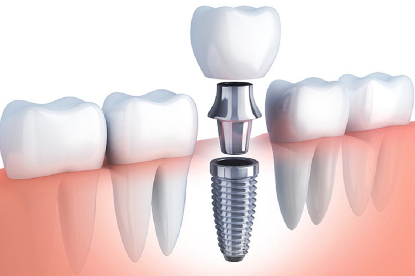 Trồng răng bằng cấy ghép Implant được khuyến khích thực hiện sau khi nhổ răng bị sâu