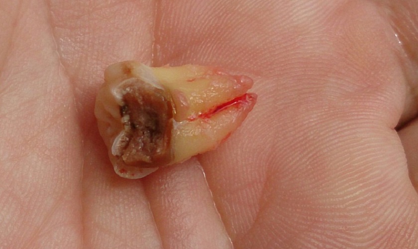 Nhổ răng khôn là biện pháp điều trị tối ưu nhất nếu chiếc răng này bị sâu