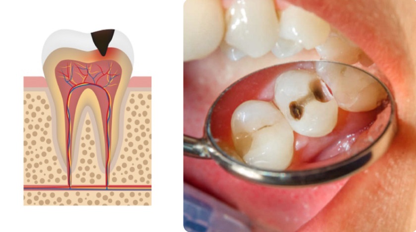 Giai đoạn sâu răng nặng khiến ngà răng bị tổn thương