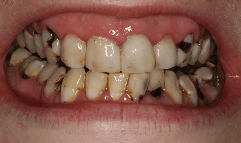 Răng bị sâu khiến hàm răng mất đi vẻ đẹp thẩm mỹ