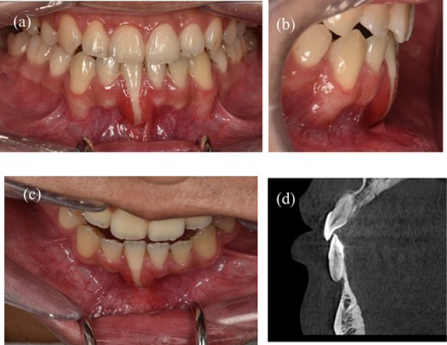 A 22-year-old man exhibits gingival recession in the lower left central incisor