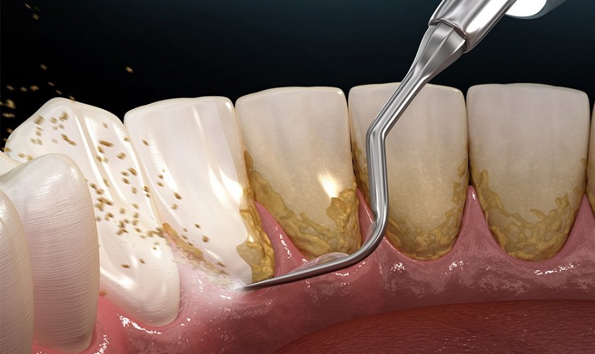 Thuốc tẩy trắng răng rất dễ gây kích ứng với người có răng nhạy cảm