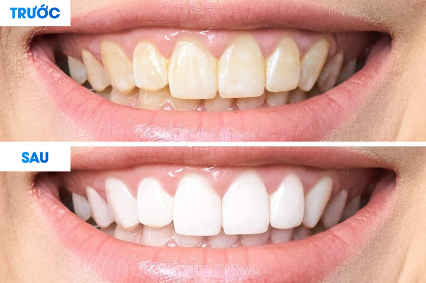Răng trắng sáng dài lâu sau khi tẩy trắng răng với công nghệ Laser Whitening
