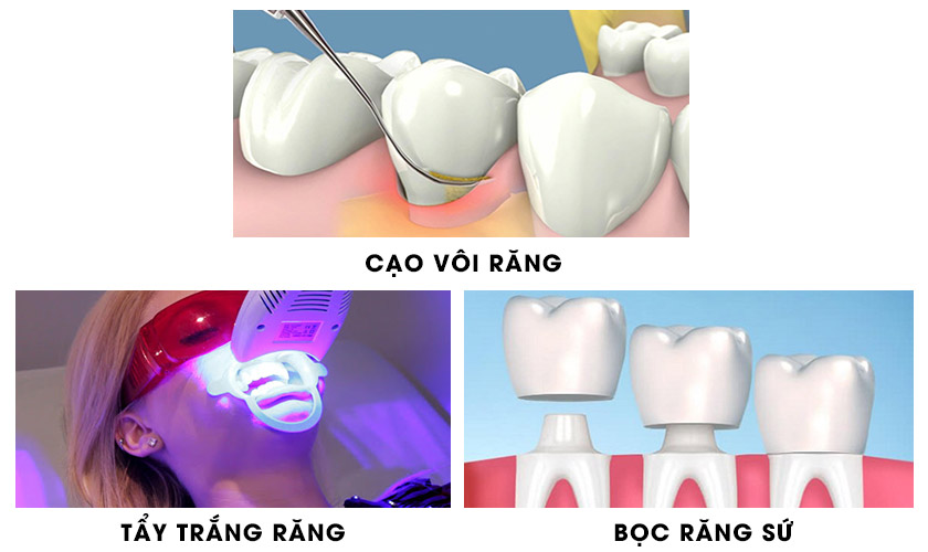 Các giải pháp khắc phục răng xỉn màu