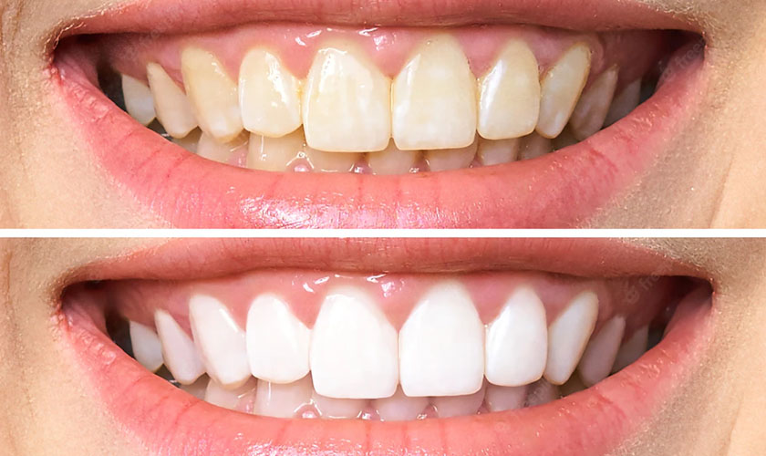 Trước và sau khi làm trắng răng