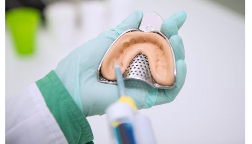 Lấy dấu hàm răng giúp thiết kế máng tẩy trắng răng phù hợp