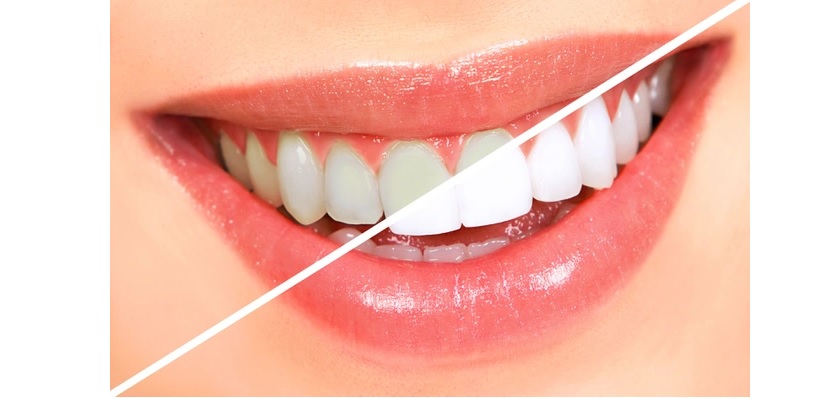 Răng trước và sau khi tẩy trắng