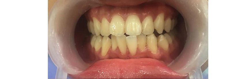 Răng bị nhiễm màu Răng bị nhiễm màu