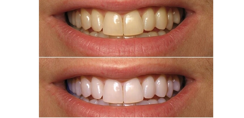 Tuyệt đối không tẩy trắng răng sau khi tiến hành trám răng Tuyệt đối không tẩy trắng răng sau khi tiến hành trám răng