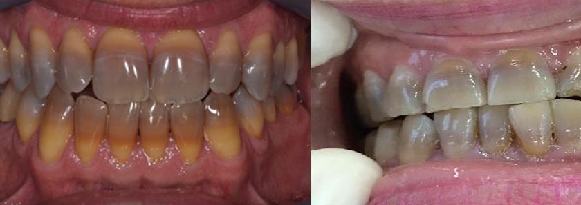 Răng bị nhiễm Tetracycline