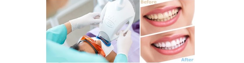 Tẩy trắng răng giúp răng trắng sáng trong thời gian ngắn mà không cần mài răng