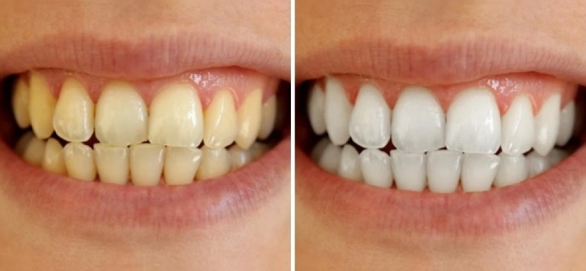 Laser Whitening sở hữu nhiều ưu điểm vượt trội