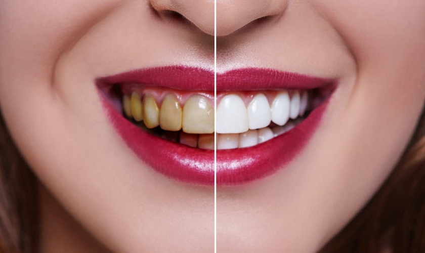 Tẩy trắng răng giá bao nhiêu sẽ tùy thuộc vào phương pháp mà bạn lựa chọn