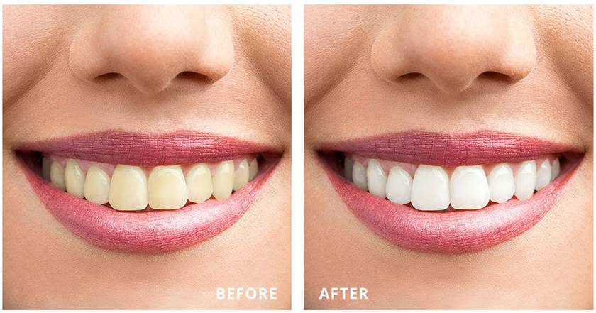 Tẩy trắng răng sẽ mang đến cho bạn hàm răng trắng sáng tự nhiên