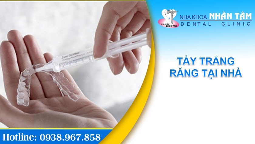 Tẩy trắng răng tại nhà bằng máng tẩy