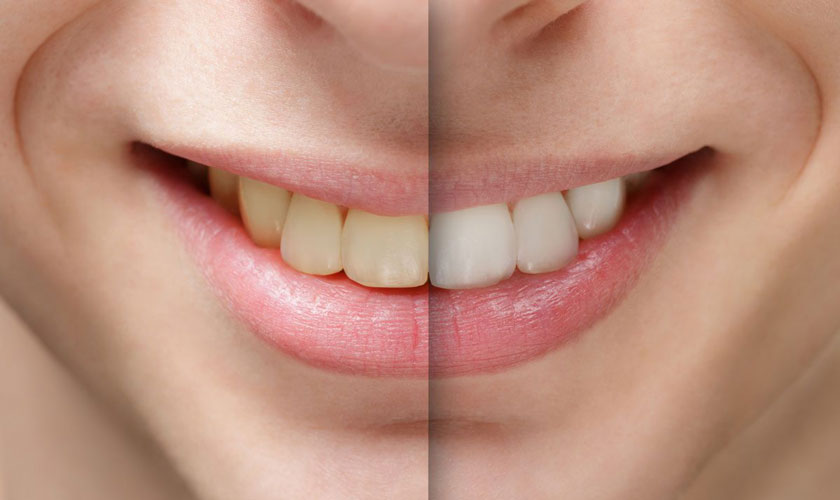 Cách tẩy trắng răng được ưa chuộng nhất hiện nay