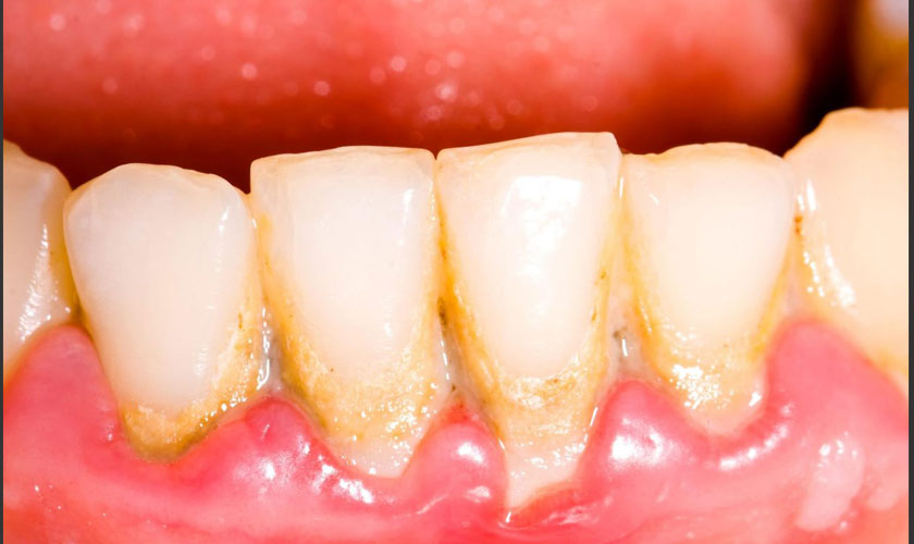 Răng bị ố vàng do vôi răng