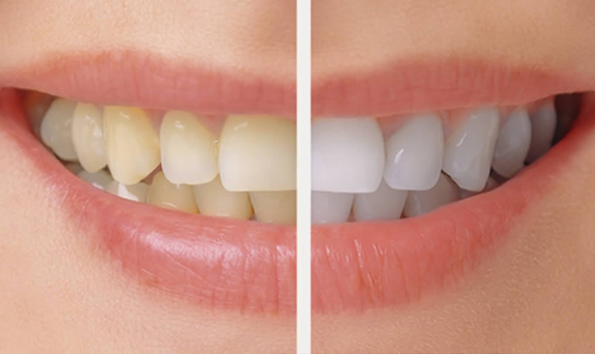 Làm trắng răng cấp tốc với công nghệ Laser Whitening