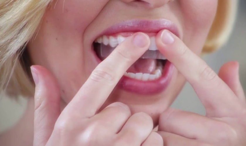 Miếng dán trắng răng nếu không được sử dụng đúng cách sẽ gây nên nhiều ảnh hưởng