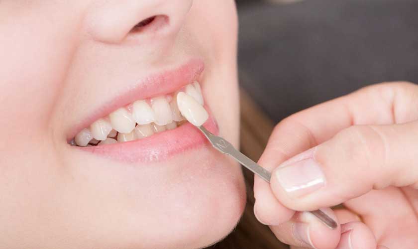 Dán răng sứ Veneer