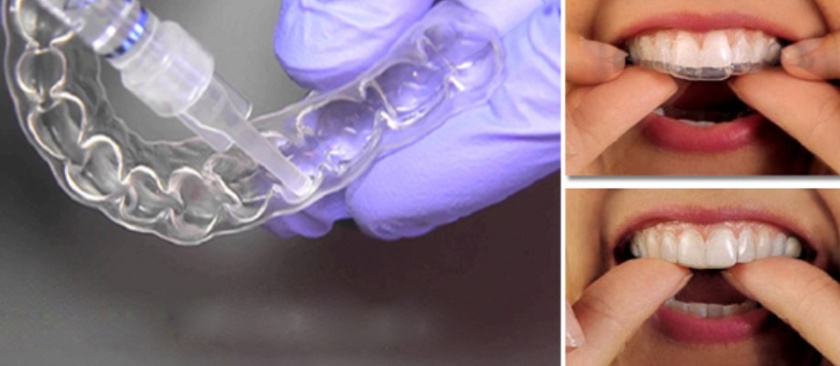 Cần sử dụng máng tẩy trắng răng đúng cách để đảm bảo hiệu quả và an toàn