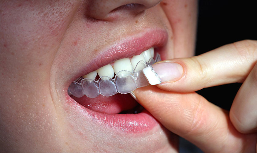 Quy trình tẩy trắng răng sử dụng máng tại nhà được thực hiện như thế nào?
