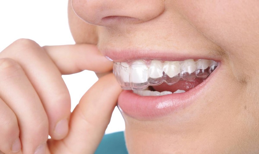 Tẩy trắng răng bằng máng tẩy trắng tại nhà Tẩy trắng răng bằng máng tẩy trắng tại nhà