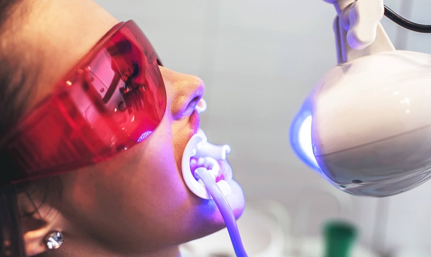 Tẩy trắng răng bằng công nghệ cao Tẩy trắng răng bằng công nghệ cao