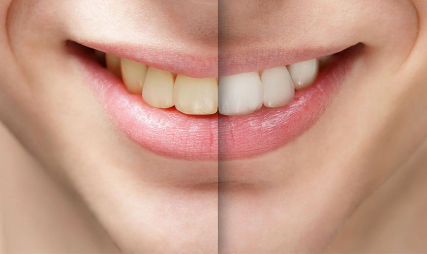 Tẩy trắng răng giúp bạn sở hữu hàm răng trắng sáng tự nhiên