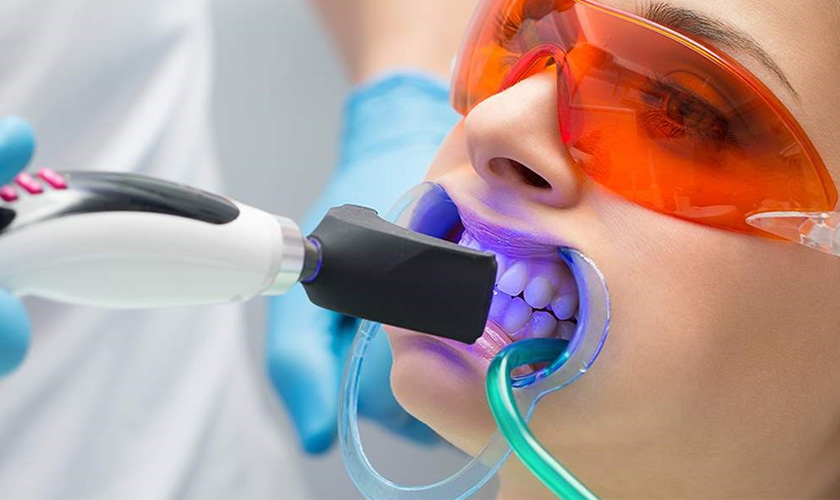 Tẩy trắng răng bằng công nghệ Laser Whitening